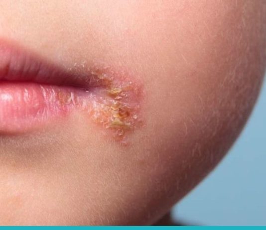 ჰერპესის მკურნალობა უმოკლეს დროში, მარტივად და იაფად