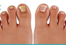 სცადეთ ეს მეთოდები და ფრჩხილის სოკო აღარ შეგაწუხებთ