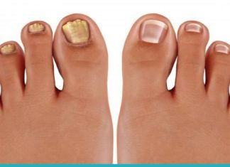 სცადეთ ეს მეთოდები და ფრჩხილის სოკო აღარ შეგაწუხებთ