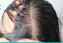 ეფექტული ხალხური რეცეფტები ცხიმიანი თმისთვის