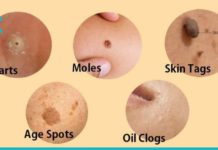 ამ მეთოდებით ხალებს, მეჭეჭებს, ფერიმჭამელებსა და პიგმენტურ ლაქებს მოიშორებთ