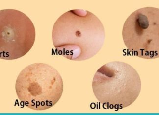 ამ მეთოდებით ხალებს, მეჭეჭებს, ფერიმჭამელებსა და პიგმენტურ ლაქებს მოიშორებთ