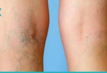 რა უნდა გააკეთოთ, რომ ფეხებზე ვენები არ შეგეტყოთ? ყველაზე ეფექტური რეცეპტია