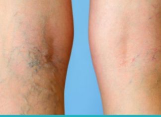 რა უნდა გააკეთოთ, რომ ფეხებზე ვენები არ შეგეტყოთ? ყველაზე ეფექტური რეცეპტია