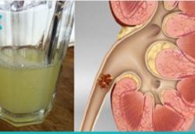 4 ეფექტური საშუალება თირკმელში ქვების დასაშლელად