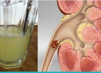 4 ეფექტური საშუალება თირკმელში ქვების დასაშლელად