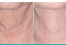 ებრძოლეთ კისრის დაბერებას ამ ეფექტური რეცეპტით!