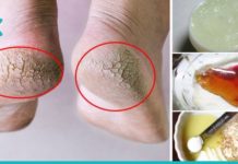 5 ყველაზე ეფექტური რეცეპტი გამომშრალი და დამსკდარი ქუსლების გაჯანსაღებისთვის