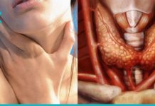 მოამზადეთ ეს ფაფა თუ ფარისებრი ჯირკვალი გაწუხებთ. ძალიან მარტივია