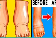 ექვსი ნატურალური გზა შესიებული კიდურების სამკურნალოდ – მარტივზე მარტივი მეთოდები !