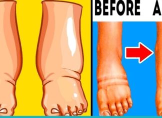 ექვსი ნატურალური გზა შესიებული კიდურების სამკურნალოდ – მარტივზე მარტივი მეთოდები !