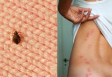 ეფექტური საშუალება, რომელიც მწერის ნაკბენს სამუდამოდ დაგავიწყებთ