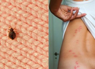 ეფექტური საშუალება, რომელიც მწერის ნაკბენს სამუდამოდ დაგავიწყებთ