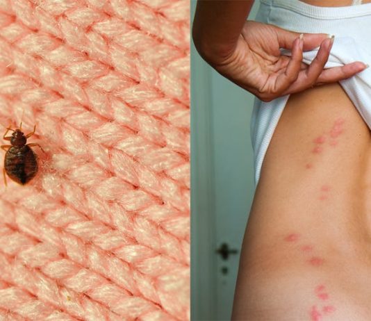 ეფექტური საშუალება, რომელიც მწერის ნაკბენს სამუდამოდ დაგავიწყებთ