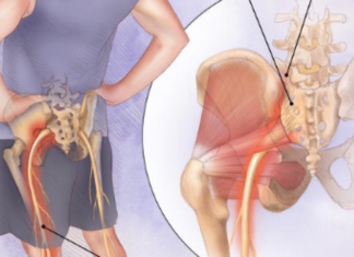 განიკურნეთ საჯდომის ნერვის ანთებისგან უმოკლეს დროში ამ მეთოდით