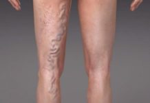 როგორ ვუმკურნალოთ ვენებს სახლის პირობებში?