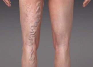 როგორ ვუმკურნალოთ ვენებს სახლის პირობებში?