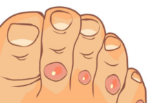 მაზოლების (კოჟრების) მოცილება ხალური მეთოდით გაგიმარტივებთ ცხოვრებას