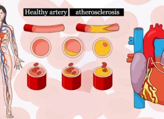 ხალხური საშუალება სისხლძარღვების გასაწმენდად! ამიერიდან ათეროსკლეროზს დაივიწყებთ!