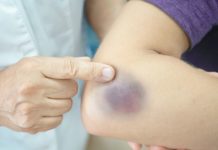 რა განაპირობებს ჰემატომის გაჩენას სხეულზე?