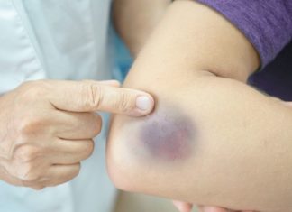 რა განაპირობებს ჰემატომის გაჩენას სხეულზე?