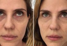 7 მეთოდი, რომლებიც თვალების ირგვლივ სიშავესა და შეშუპებას მოგაცილებთ.. გაახალგაზრდავდით!