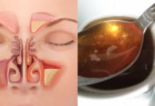 დაემშვიდობეთ ჰაიმორიტით გამოწვეულ ტანჯვას. სცადეთ ეს რეცეპტი!