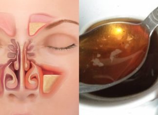 დაემშვიდობეთ ჰაიმორიტით გამოწვეულ ტანჯვას. სცადეთ ეს რეცეპტი!