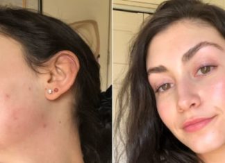 ჰორმონალური აკნეს სამკურნალო საშუალებები: 8 მკურნალობის მეთოდი, რომელიც უნდა სცადოთ.