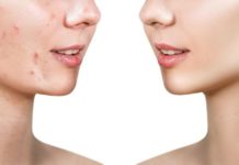 საოცრად ეფექტური ნიღბები პრობლემური კანისთვის, რომლებიც ებრძვის აკნეს, ყველა სახის გამონაყარს