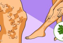 როგორ გავიქროთ ვარიკოზული ვენები ოხრახუშის დახმარებით? იაფი და მარტივი მეთოდი