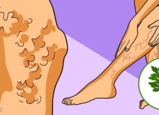 როგორ გავიქროთ ვარიკოზული ვენები ოხრახუშის დახმარებით? იაფი და მარტივი მეთოდი