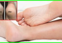 ქუსლები აღარ აგექერცლებათ – ეს მარტივი საშუალება სამოდამოდ აქრობს ქუსლის დახეთქვის რისკს