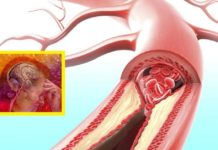 Სისხლძარღვების გაძლიერების რამდენიმე რეცეფტი