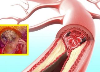 Სისხლძარღვების გაძლიერების რამდენიმე რეცეფტი