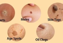 ასე ხალებს, მეჭეჭებს, ფერიმჭამელებსა და პიგმენტურ ლაქებს ნატურალური გზით მოიშორებთ