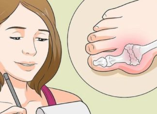 მოიშორეთ ბუნიონი ამ 5 ხალხური მეთოდით