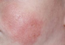 დიათეზის მკურნალობა და პროფილაქტიკა ხალხური მეთოდებით