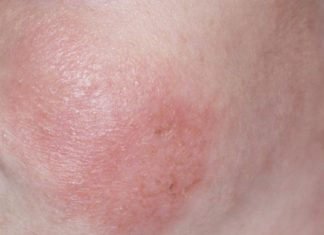 დიათეზის მკურნალობა და პროფილაქტიკა ხალხური მეთოდებით