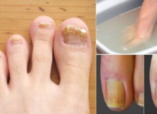 მხოლოდ და მხოლოდ 2 ინგრედიენტი, რომელიც ფეხის სოკოსგან გაგათავისუფლებთ!