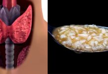 საოცრად ეფექტური ხალხური მეთოდები ჩიყვის სამკურნალოდ