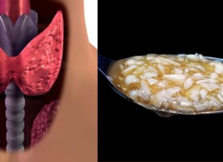 საოცრად ეფექტური ხალხური მეთოდები ჩიყვის სამკურნალოდ