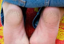 7 მეთოდი გაუხეშებული და დამსკდარი ქუსლების მოსარჩენად. შედეგი გარანტირებულია!