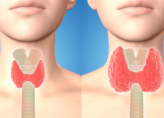 გამოიყენეთ ეს რეცეპტი და უთხარით არა ფარისებრი ჯირკვლის პრობლემებს!