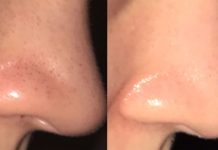 ამ ორმა პროდუქტმა შავი წერტილები სამუდამოდ გამიქრო – ნახეთ როგორ დაამზადოთ სასაწაულმოქმედი ნიღაბი