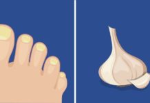 როგორ ვებრძოლოთ ფრჩხილის სოკოს? 6 ეფექტური პროდუქტი, რომელიც ამ დაავადებას დაგავიწყებთ