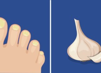 როგორ ვებრძოლოთ ფრჩხილის სოკოს? 6 ეფექტური პროდუქტი, რომელიც ამ დაავადებას დაგავიწყებთ