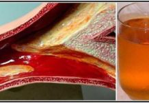 ლამის გულისშეტევა მივიღე ათეროსკლეროზის გამო. საბედნიეროდ ეს რეცეფტი დროულად მასწავლეს და გადავრჩი.