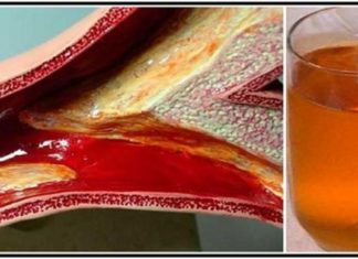 ლამის გულისშეტევა მივიღე ათეროსკლეროზის გამო. საბედნიეროდ ეს რეცეფტი დროულად მასწავლეს და გადავრჩი.