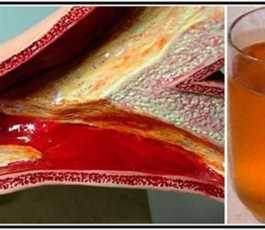 ლამის გულისშეტევა მივიღე ათეროსკლეროზის გამო. საბედნიეროდ ეს რეცეფტი დროულად მასწავლეს და გადავრჩი.